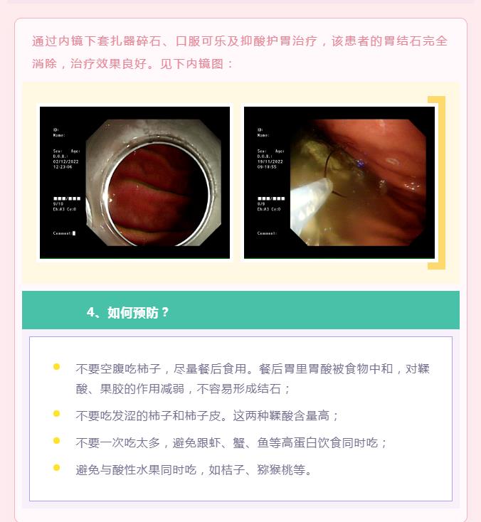 这些因素容易形成胃结石？你一定要提防！