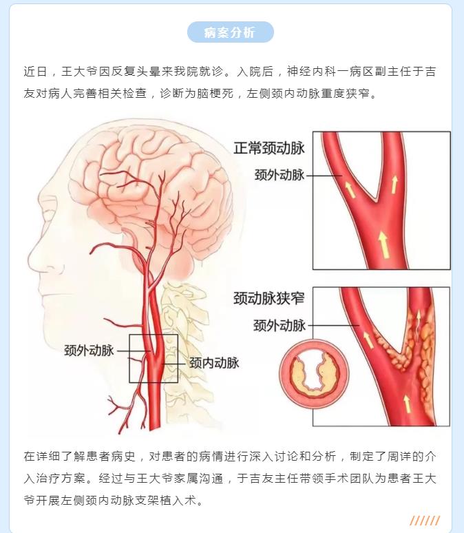 打通“大脑生命线”——颈动脉支架植入术