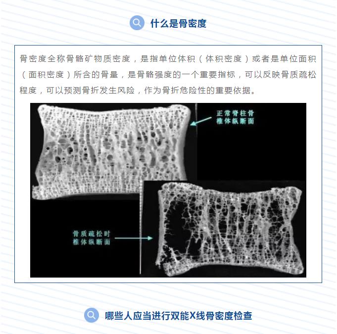 骨质疏松早知道——GE双能骨密度仪