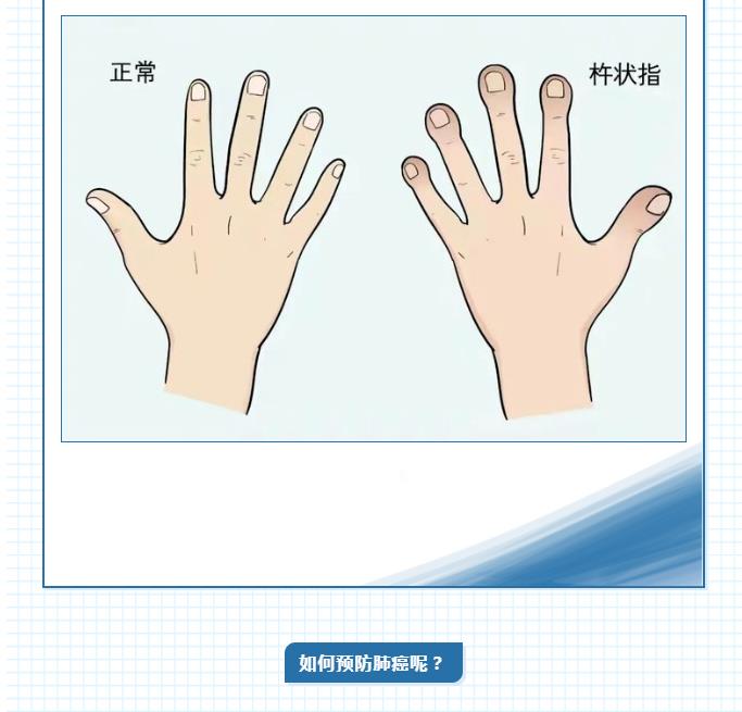 【全国肿瘤防治宣传周】“肺”腑之言，你得注意“听”