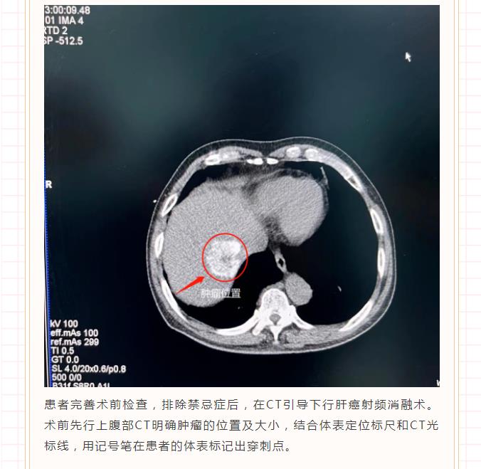 肝癌射频消融术，诠释“针尖上的艺术”