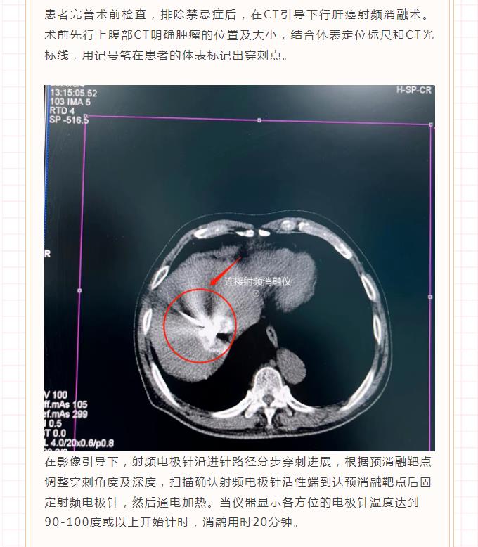 肝癌射频消融术，诠释“针尖上的艺术”