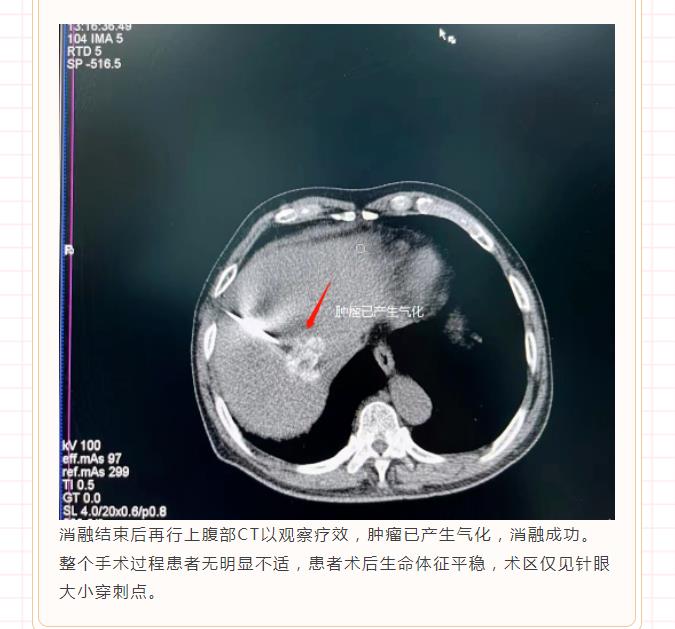 肝癌射频消融术，诠释“针尖上的艺术”