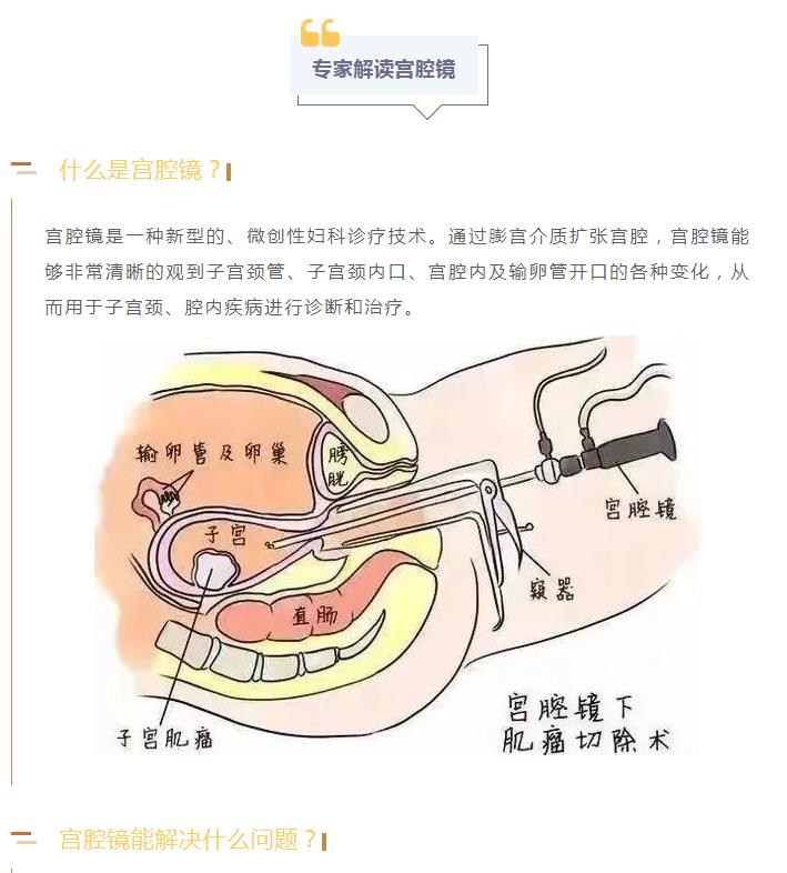 【术业有专“宫”】妇科医生的第三只眼——宫腔镜