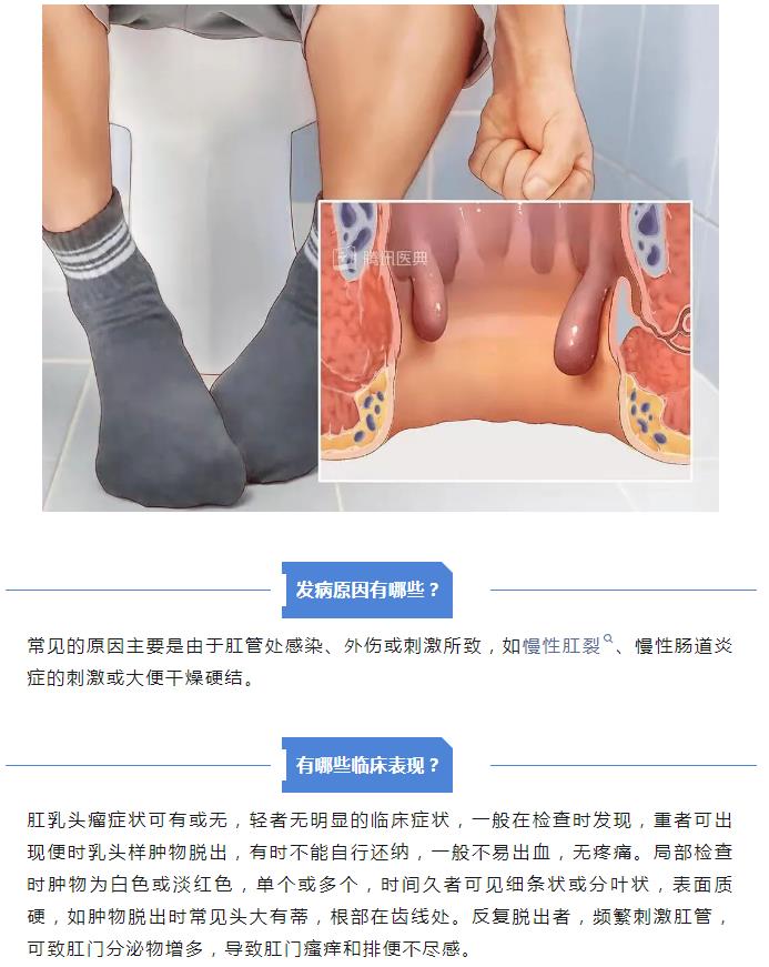 案例警示：千万不要把“肛乳头瘤”当痔疮