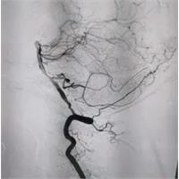 聚焦临床 | 迈入神经介入时代！全脑血管造影术