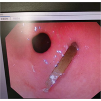 异物嵌顿 内镜解忧 | 且看我院消化内科医生巧施技法